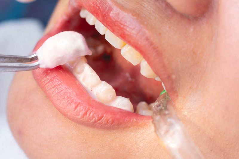 fluoride treatment thornton
